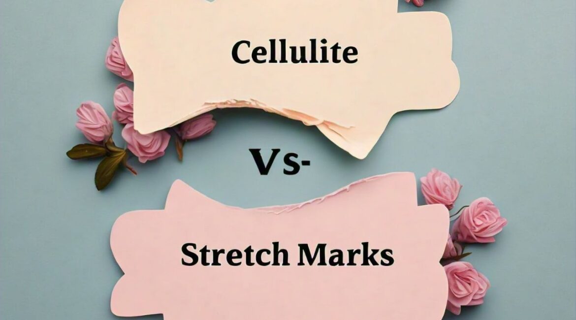 Cellulite and Stretch Marks